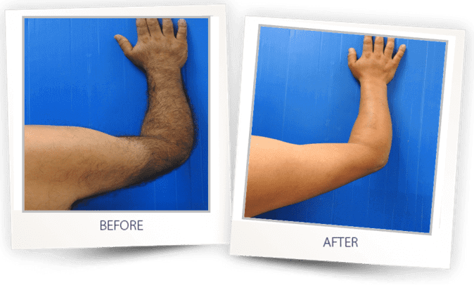Laser Hair Removal Before & after Treatment result in Bellevue, WA | MIYA Aesthetics & Wellness