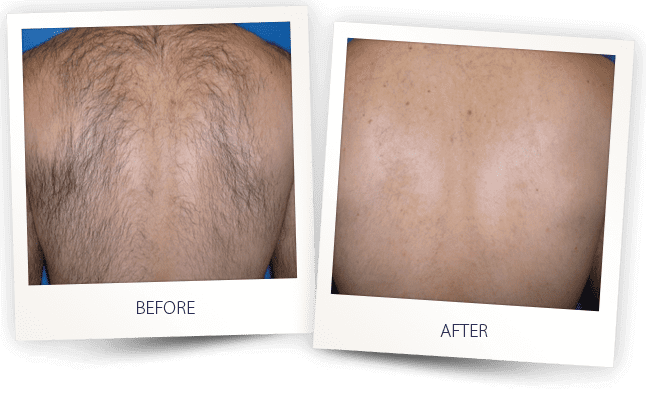 Laser Hair Removal Before & after Treatment result in Bellevue, WA | MIYA Aesthetics & Wellness
