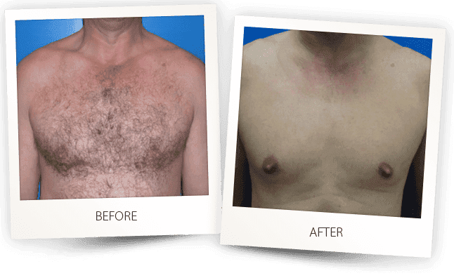 Laser Hair Removal Before & after Treatment result in Bellevue, WA | MIYA Aesthetics & Wellness