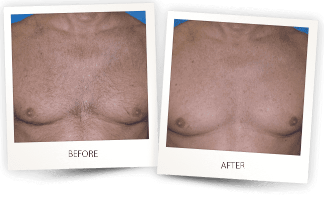 Laser Hair Removal Before & after Treatment result in Bellevue, WA | MIYA Aesthetics & Wellness