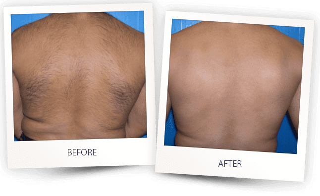 Laser Hair Removal Before & after Treatment result in Bellevue, WA | MIYA Aesthetics & Wellness