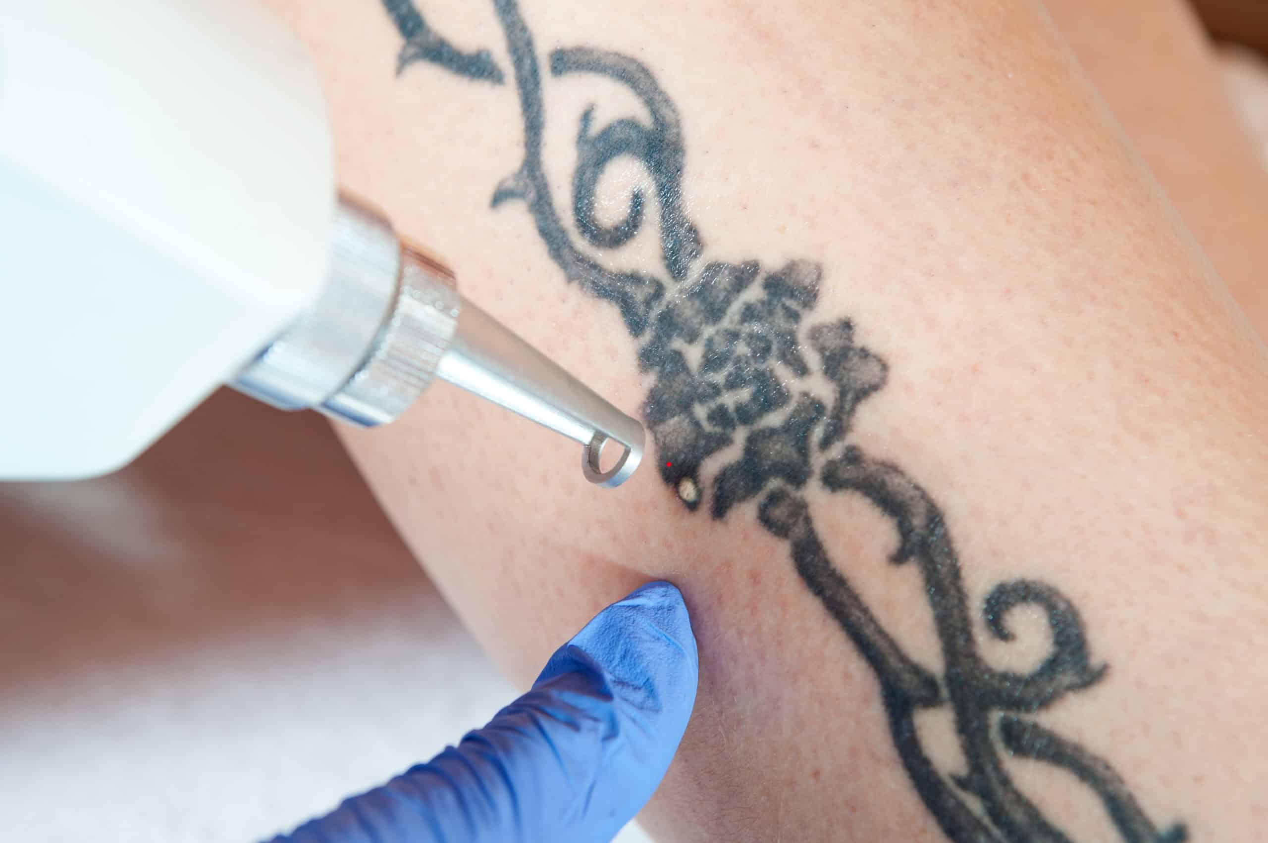 The Ultimate Guide to Laser Tattoo Removal: Say Goodbye to Unwanted Ink